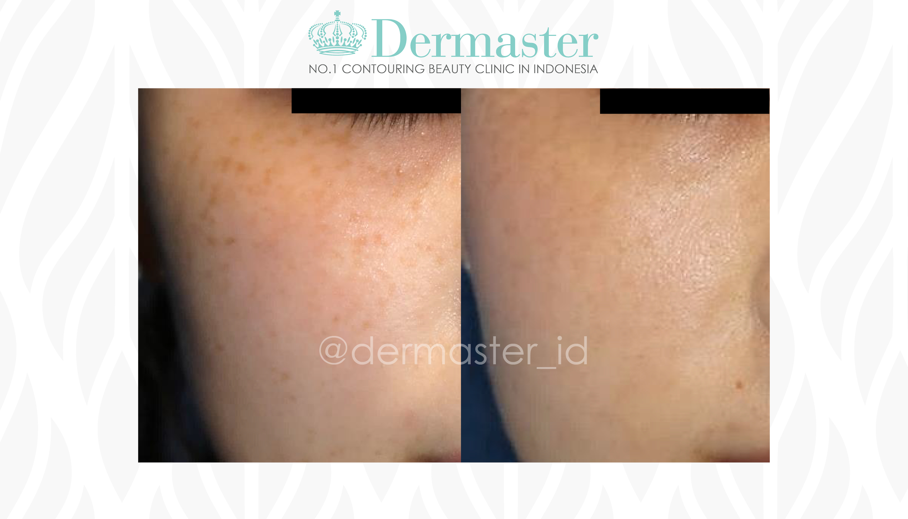 Pico Derma Dermaster