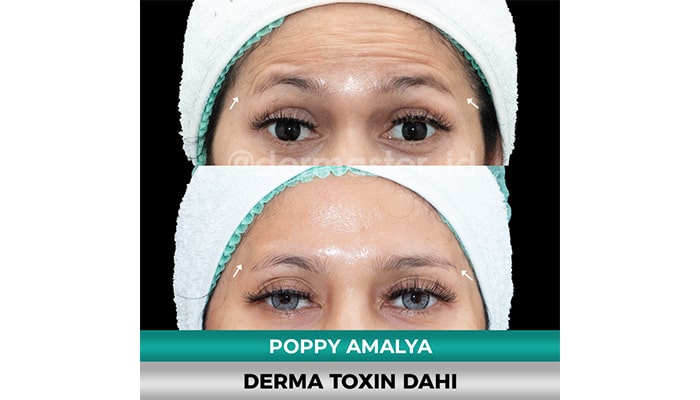 botox dahi