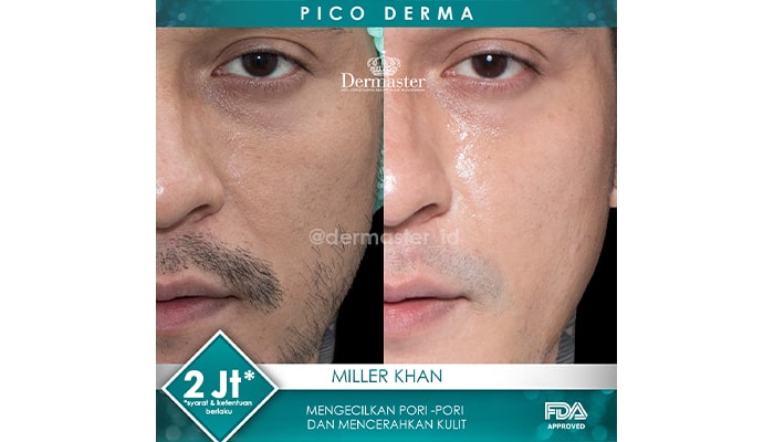 perawatan laser untuk flek hitam