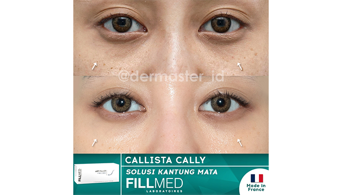 fillmed face filler