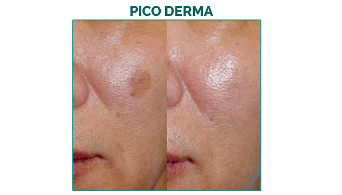 BA pico laser-pico derma