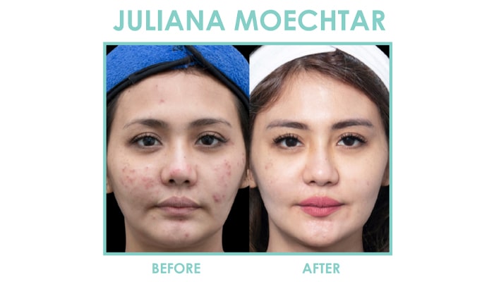 Klinik terbaik menghilangkan jerawat