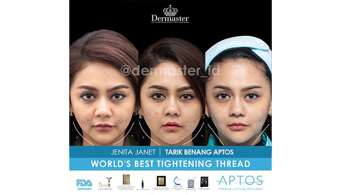 Klinik Tanam Benang Terbaik