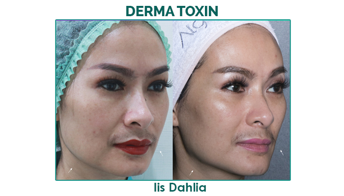 perawatan botox