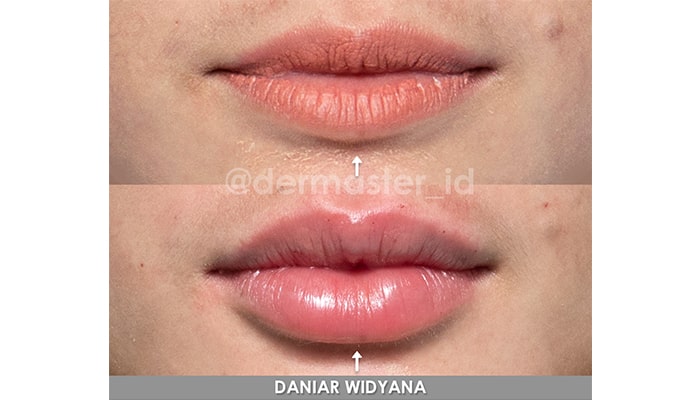 Filler Pluryal Area Bibir