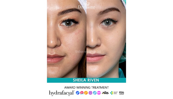 Hydrafacial