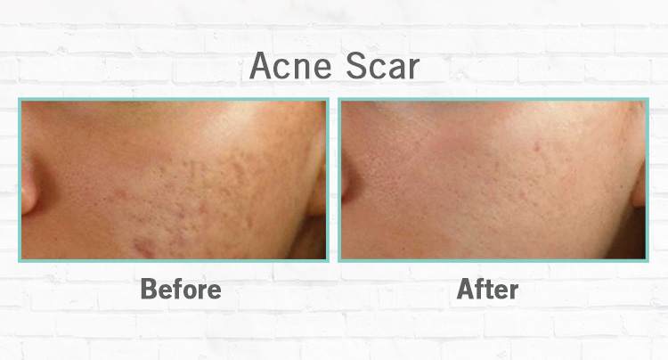 Perawatan Untuk Menghilangkan Jerawat Dermaster